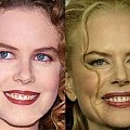 #OperacjePlastyczne #botox #kidman